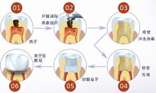根管治疗过程