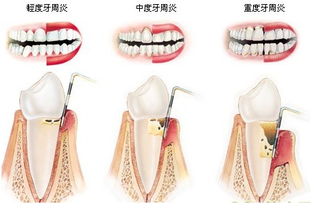 口腔患有牙周炎是什么症状